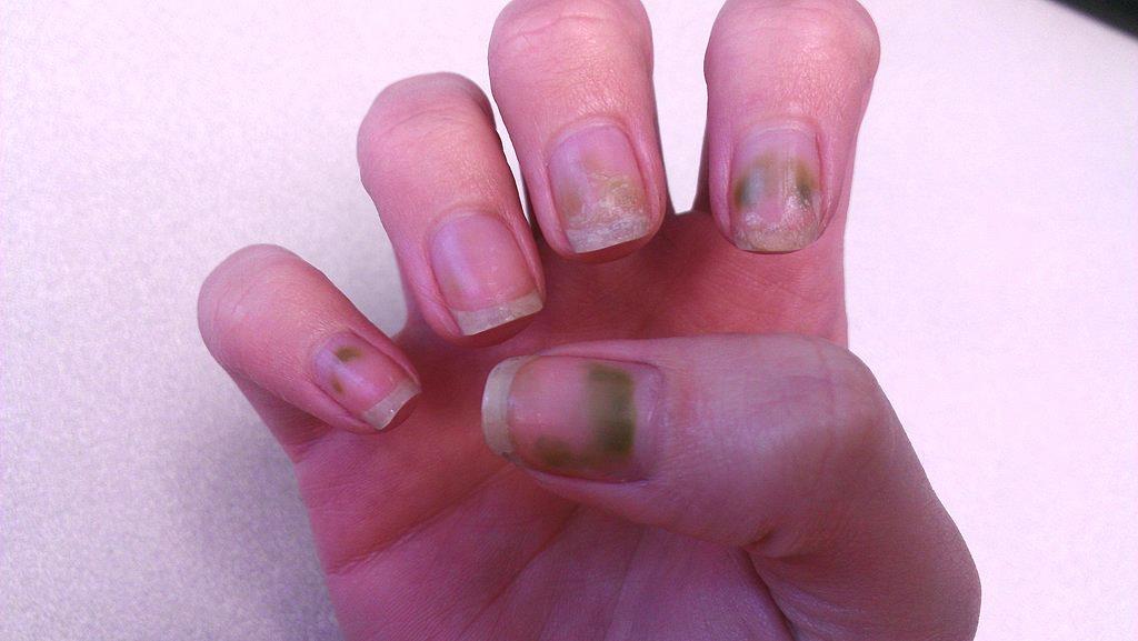 Pseudomonas Aeruginosa Nail Infection Treatment 